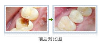 牙齿有洞补一下多少钱