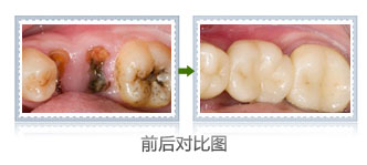 牙齿蛀掉了怎么办