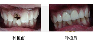 种一颗牙大概需要多少钱