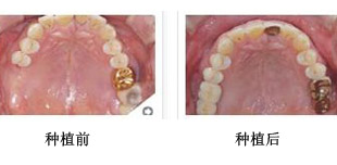 门牙脱落可以种牙吗